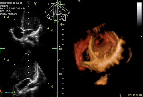 3-D Echocardiogram