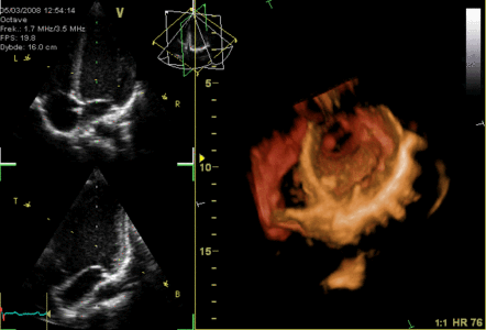 3-D Echocardiogram