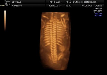 File:Fetal spine 19 weeks Dr Wolfgang Moroder.theora.ogv